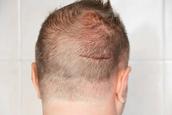 Large scratch on the head of a man from falling head on a corner in the pool, a wound from hitting his head, medicine and emergency care