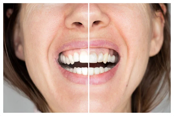 Women's teeth before and after bleaching an example on the same background, dentistry, an example with teeth whitening