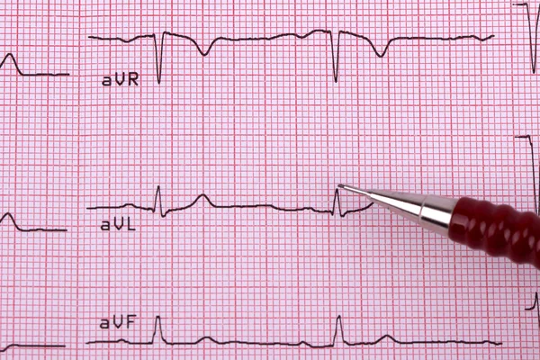 Cardiograma cardíaco saudável — Fotografia de Stock