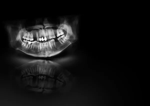 Dents à rayons X mâchoire crâne humain. Photo panoramique négative image faciale de la bouche jeune homme adulte. Modèle d'échantillon d'élément de conception médicale papier horizontal format A4. Voir plus d'image dans ma galerie — Photo