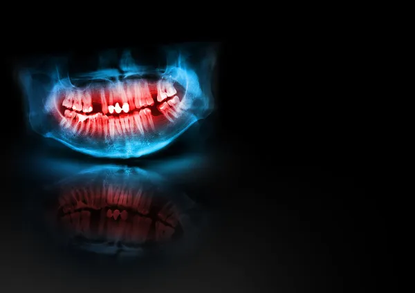 Μπλε και κόκκινο ακτινογραφία δοντιών γνάθου κρανίο με λάμψη, σκιά και προβληματισμού σε μαύρο φόντο. πανοραμική αρνητική εικόνα του προσώπου του ανθρώπου. ιατρική σχεδιασμός στοιχείο δείγμα κενό πρότυπο οριζόντια χαρτί μεγέθους Α4 — Φωτογραφία Αρχείου