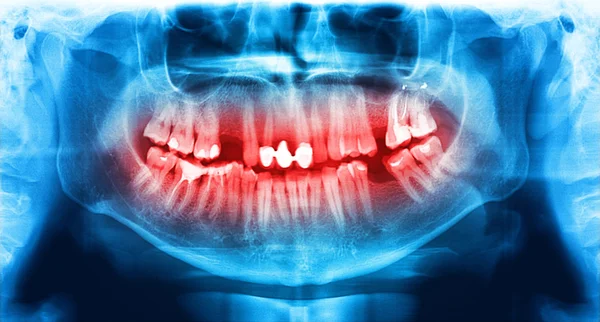 Mavi ve kırmızı x-ışını diş tarama çene kemiği. — Stok fotoğraf