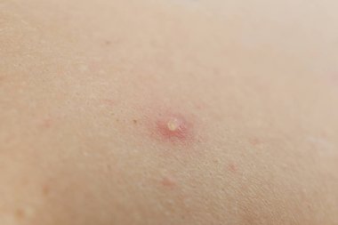 Deri sorunu kavramı, sivilce, yakın çekim.