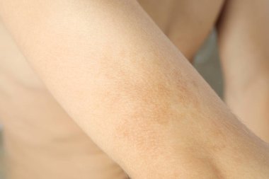 Cilt bakımı kavramı, kahverengi benekli genç adamın eli.