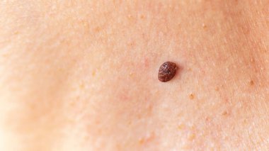 Olgun ciltteki büyük köstebek ya da nevus fotokopi alanı ile makro fotoğrafçılığı kapat. Bir kadının derisinde iyi huylu lezyon. Deri hastalığı tedavisi kavramı.
