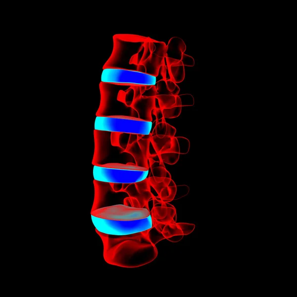 3d rendered - spine structure on black background with blue spinal disc - side view — Stock Image 3d rendered - spine structure on black background with blue spinal disc - side view Stock Picture