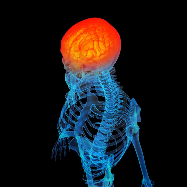 3D wytopione ludzkiego bólu głowy — Zdjęcie stockowe