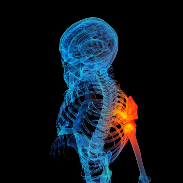 3D-renderade mänskliga skuldra smärta — Stockfoto