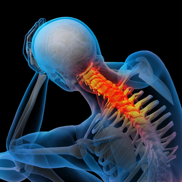 3D gerenderte Illustration - Nackenschmerzen — Stockfoto