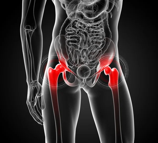 3d rendered, medical illustration of a painful hip joint -front — Stock Photo, Image