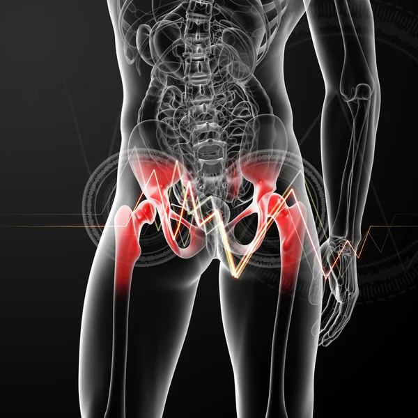 3d renderizado, ilustración médica de una articulación dolorosa de la cadera - vista posterior —  Fotos de Stock