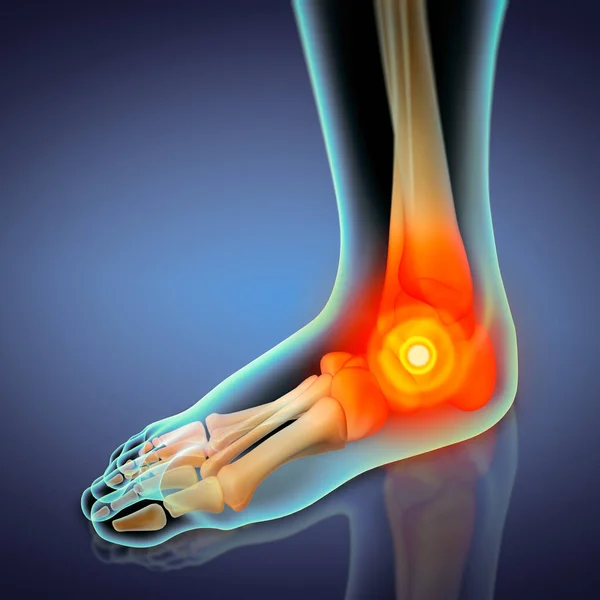 Illustration Ankle Pain Detail — 图库照片#