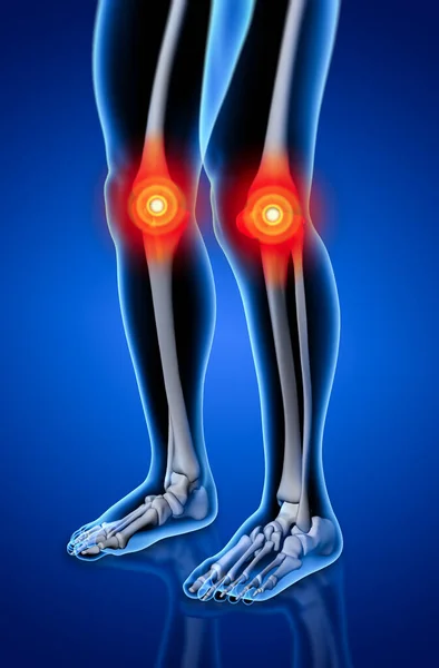 人体膝关节疼痛与骨架的腿的解剖 — 图库照片#