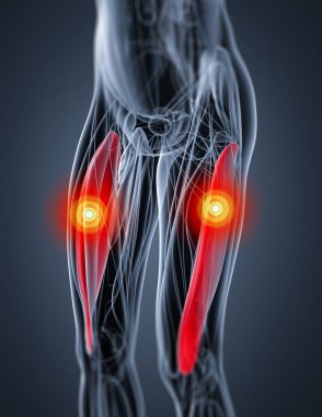 vastus kasılmasına tıbbi çizimi