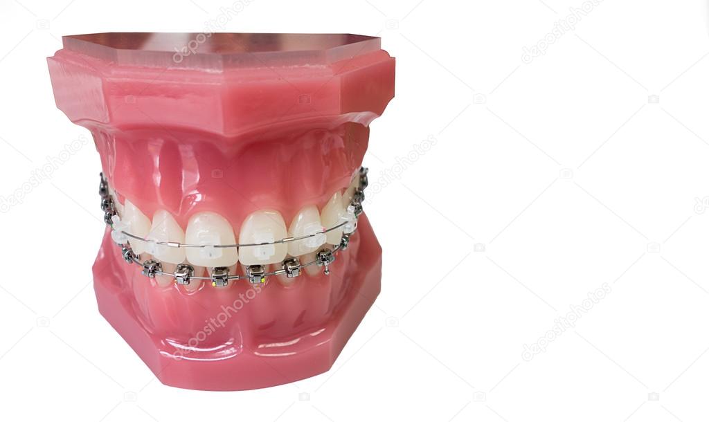 Dental braces model