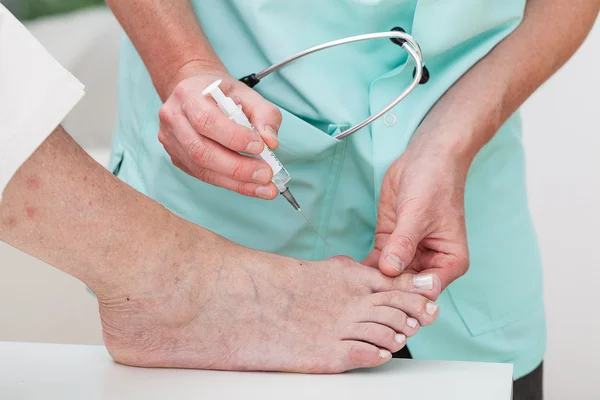 Injection to bunion — Stock Photo, Image