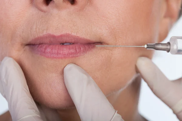 Lippen correctie met behulp van botox — Stockfoto
