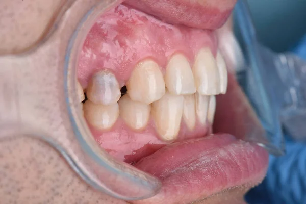 Οδοντίατρος Λήψη Φωτογραφιών Κοντινό Πλάνο Της Εξέτασης Των Δοντιών Του — Φωτογραφία Αρχείου