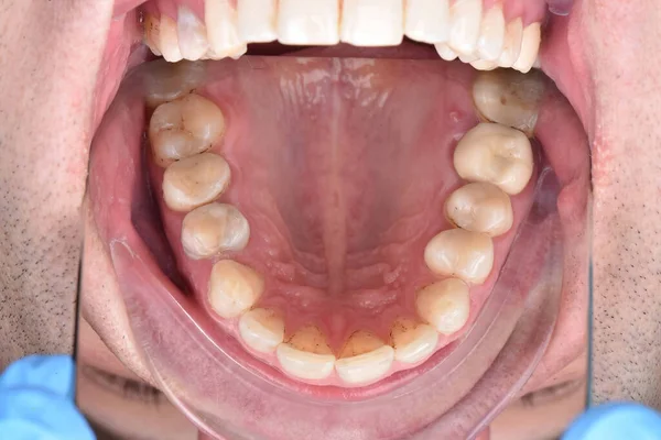 Diş hekimi, tedaviye başlamadan önce diş muayenesini tamamlıyor.