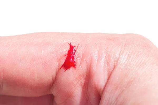 Dito ferito con taglio aperto sanguinante. — Foto Stock