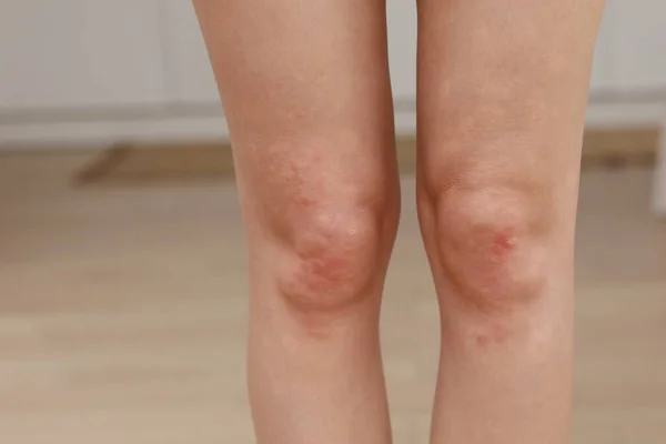 Huidallergieën Benen Huid Vrouwen Close Van Rode Puisten Een Knie — Stockfoto