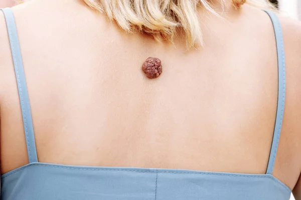 Wart Toupeira Verruga Grande Pele Doenças Pele Tumor Maligno Dermatologia — Fotografia de Stock