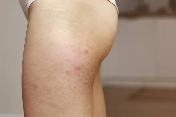 Cilt Alerjisi Kalça Derili Kadınlar Kalçadaki Kırmızı Kabarcıklar Atopik Dermatitten — Stok fotoğraf