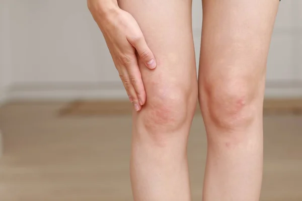 Alergias Pele Pernas Mulheres Pele Closeup Pústulas Vermelhas Joelho Uma — Fotografia de Stock