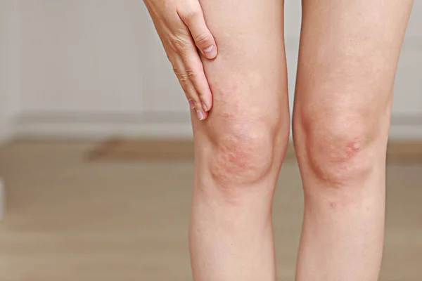 Skin Allergies Legs Skin Women Closeup Red Pustules Knee Allergic — Stock Photo, Image