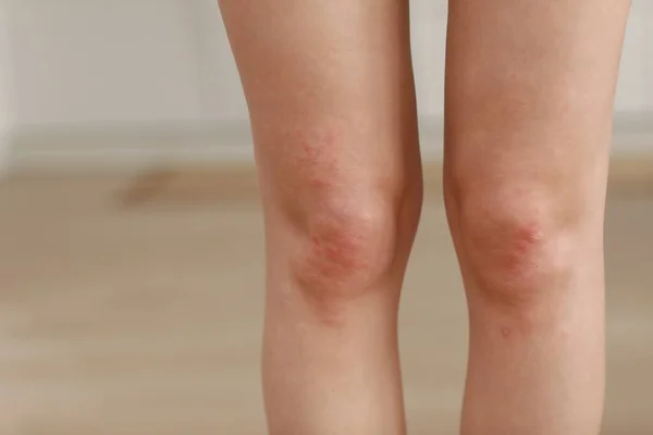 Alergii Skóry Nóg Kobiet Skóry Zbliżenie Czerwonych Krost Kolanie Reakcja — Zdjęcie stockowe