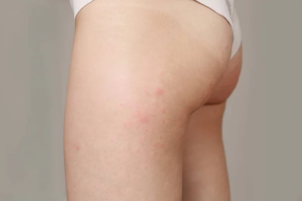 Skin Allergies Hips Skin Women Closeup Red Pustules Hips Allergic — Stock Photo, Image