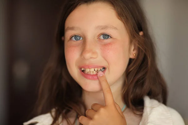 Little Girl Opens Her Mouth Shows Sick Tooth Caries Baby — Zdjęcie stockowe