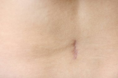 Vücudundaki ameliyattan sonra dikkatli bir yara izini kapat.