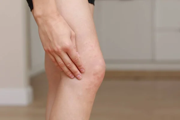 皮肤过敏 腿皮肤女人 膝盖上红色脓包的闭塞 一种由特应性皮炎引起的过敏反应 选定重点 — 图库照片