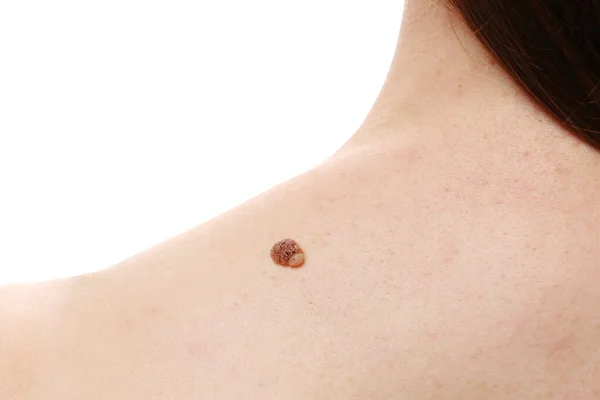 Genç Bayan Omzunda Büyük Nevus Siğili Doktor Dermatoloğunu Ziyaret Eden — Stok fotoğraf