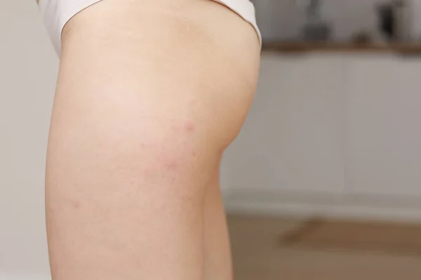 Alergias Piel Caderas Mujeres Piel Primer Plano Las Pústulas Rojas —  Fotos de Stock