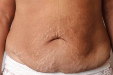 Close up of woman's belly with stretch mark loose lower abdomen skin she fat after pregnancy baby birth, studio isolated, unhealthy belly overweight excess body concept