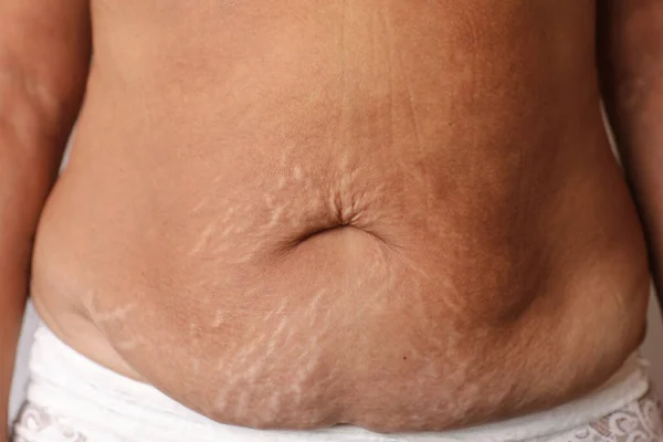 Close Woman Belly Stretch Mark Loose Lower Abdomen Skin She — Stockfoto