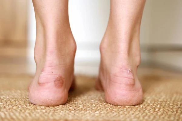 Callus Blisters Woman Feet Painful Wounds Uncomfortable Shoes Problems View — Stockfoto