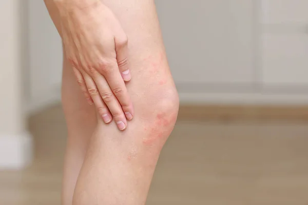 Kožní Alergie Kožní Ženy Detailní Záběr Červených Puchýřů Koleni Alergická — Stock fotografie