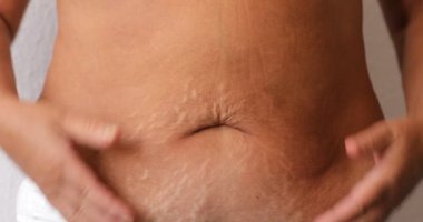 Close up of woman's belly with stretch mark loose lower abdomen skin she fat after pregnancy baby birth, studio isolated, unhealthy belly overweight excess body concept