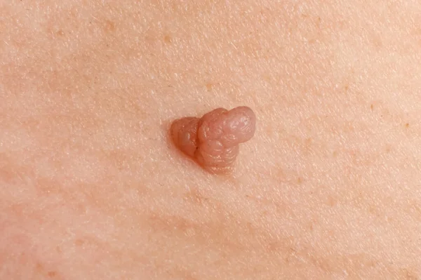 Cancer Papilloma Skin Wart Close — Stockfoto