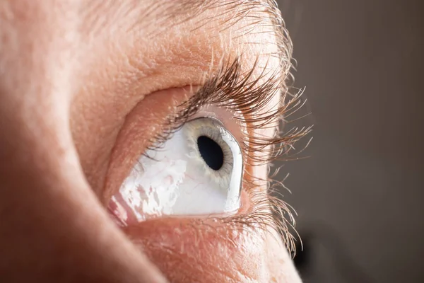Keratoconus Eye Closeup Thinning Cornea — Zdjęcie stockowe