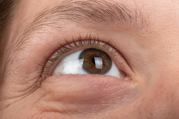Keratoconus Disease Cornea Eye Macro Fatigue Corneal Thinning — Stock Fotó