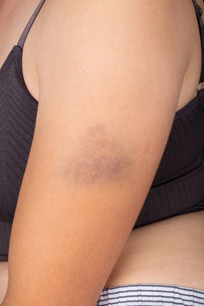 Hematoma Mujer Moretones Brazo Mujer — Foto de Stock