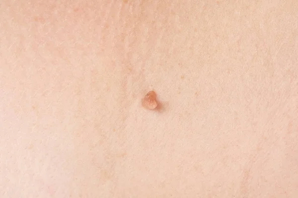 Cancer Papilloma Skin Wart Close — Foto de Stock