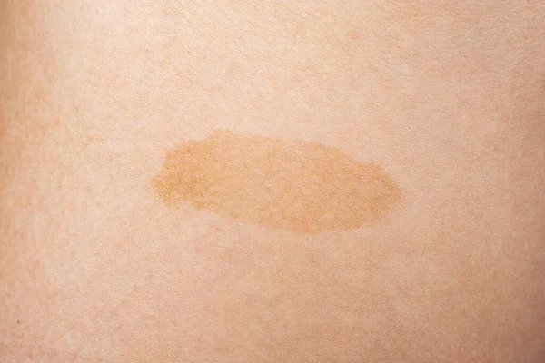 skin cancer closeup, yellow birthmark on the skin.