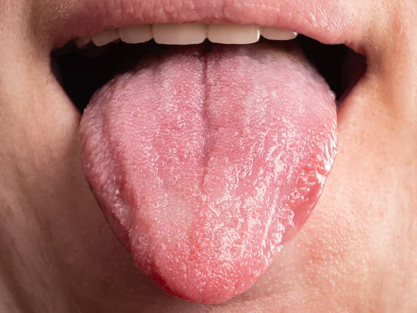 Diseases Oral Cavity Tongue Infections Cancer — Foto Stock