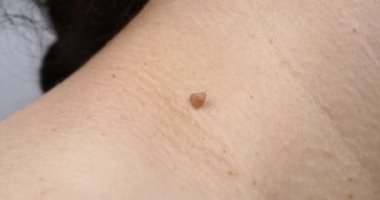 Cilt siğilinde kanserli papilloma var. Yüksek kalite 4k görüntü