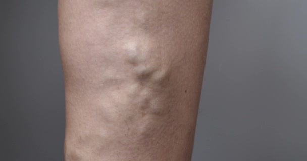 Gambe Femminili Con Vene Varicose Sfondo Grigio Filmati Alta Qualità — Video Stock